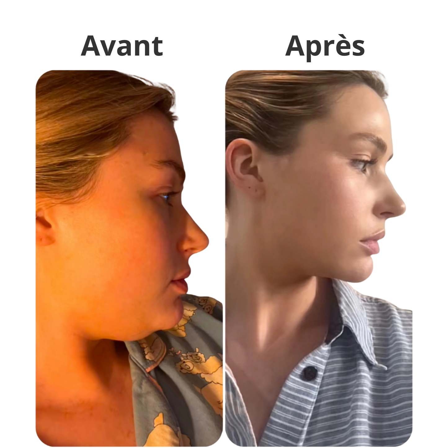 Gaine Faciale Amincissante